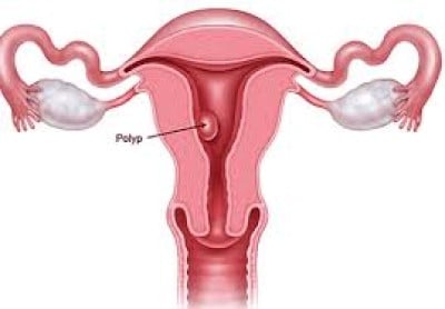 endometrial polip