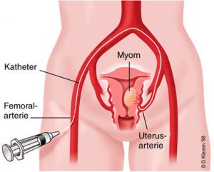 uterin arter embolizasyonu