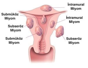 miyomların yerleşimi