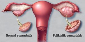 PCOS