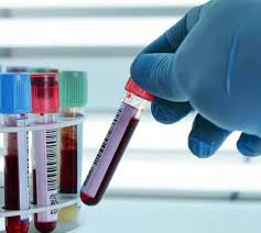 PRP, platelet rich plasma