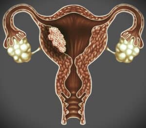 endometrial-hiperplazi